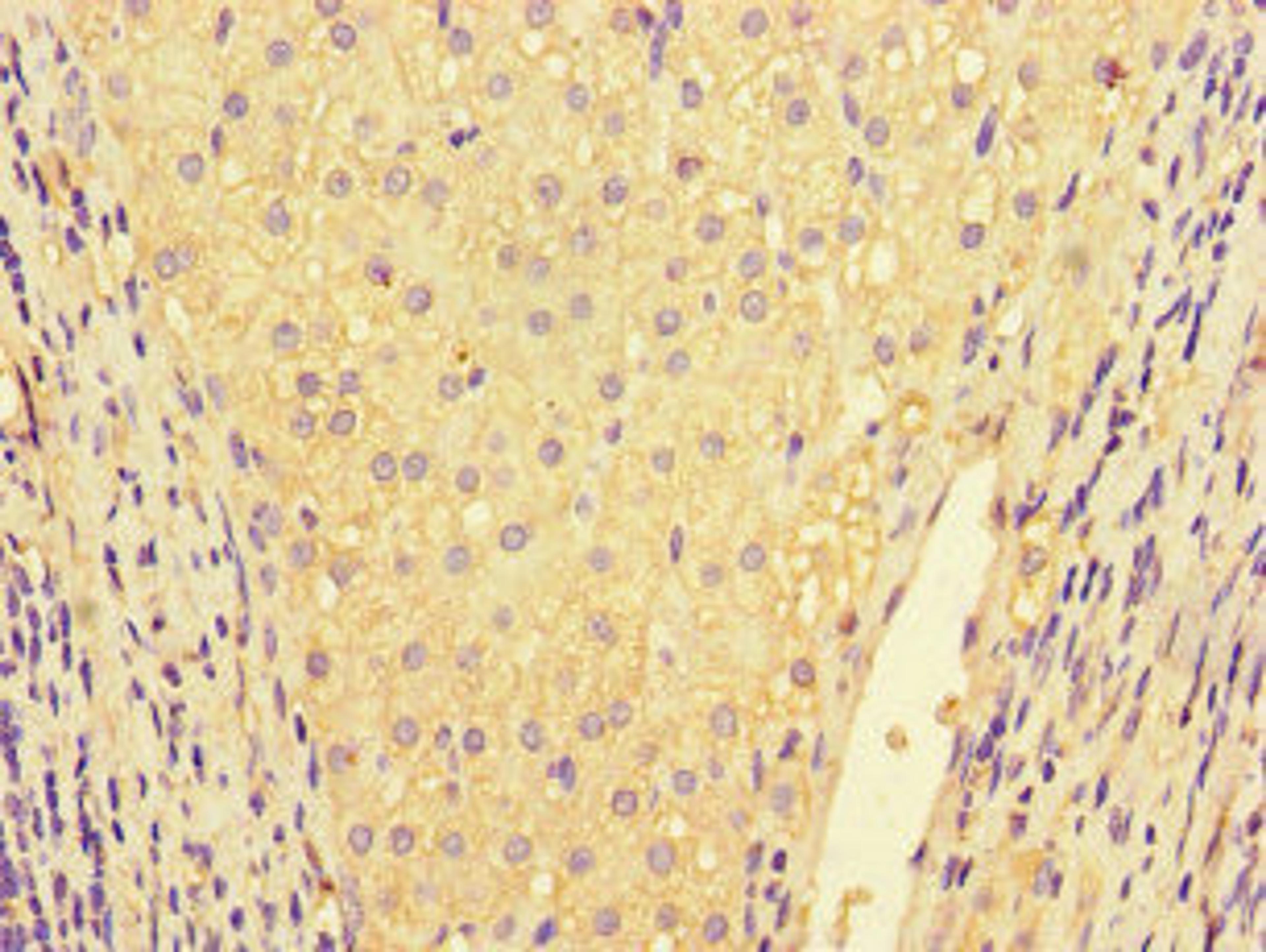 Immunohistochemistry of paraffin-embedded human liver cancer using CSB-PA08309A0Rb at dilution of 1:100