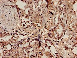 Immunohistochemistry analysis of human breast cancer using CSB-PA894382LA01HU at dilution of 1:100