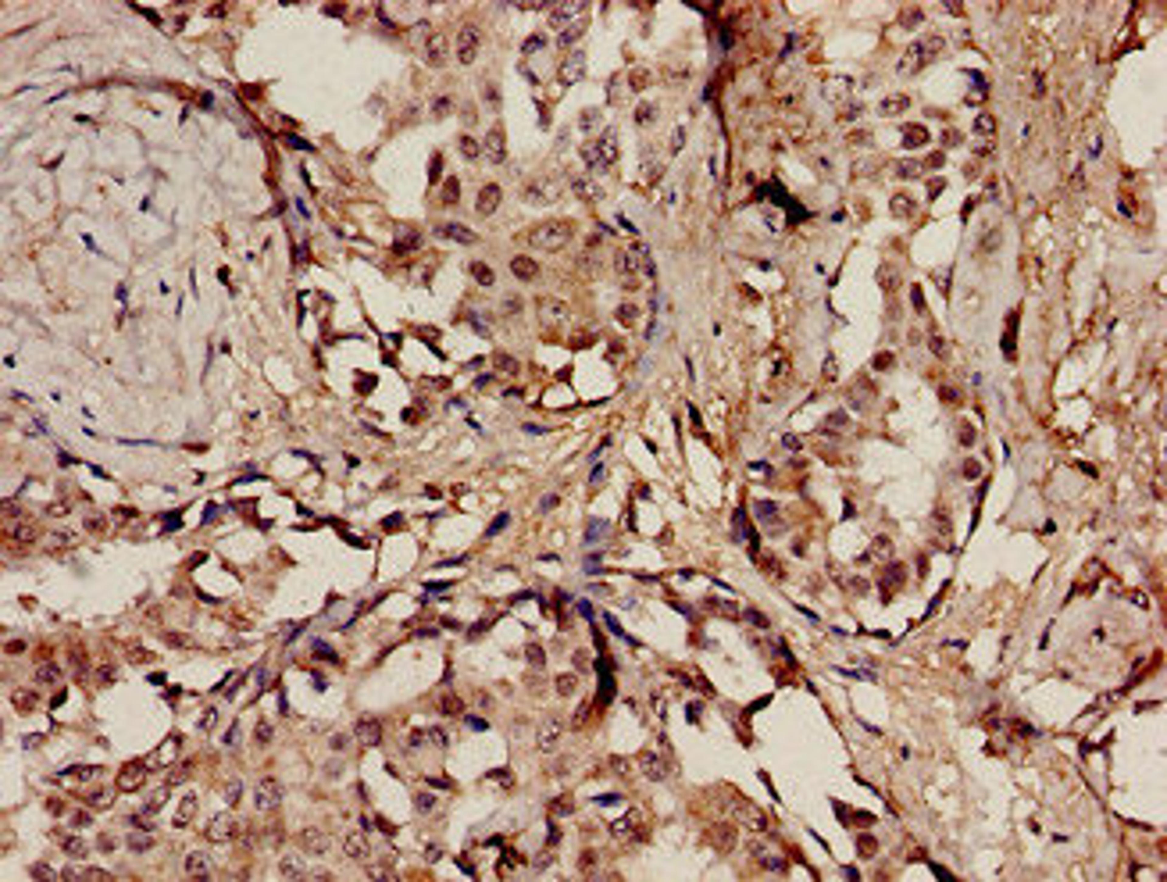 Immunohistochemistry analysis of human breast cancer using CSB-PA894382LA01HU at dilution of 1:100