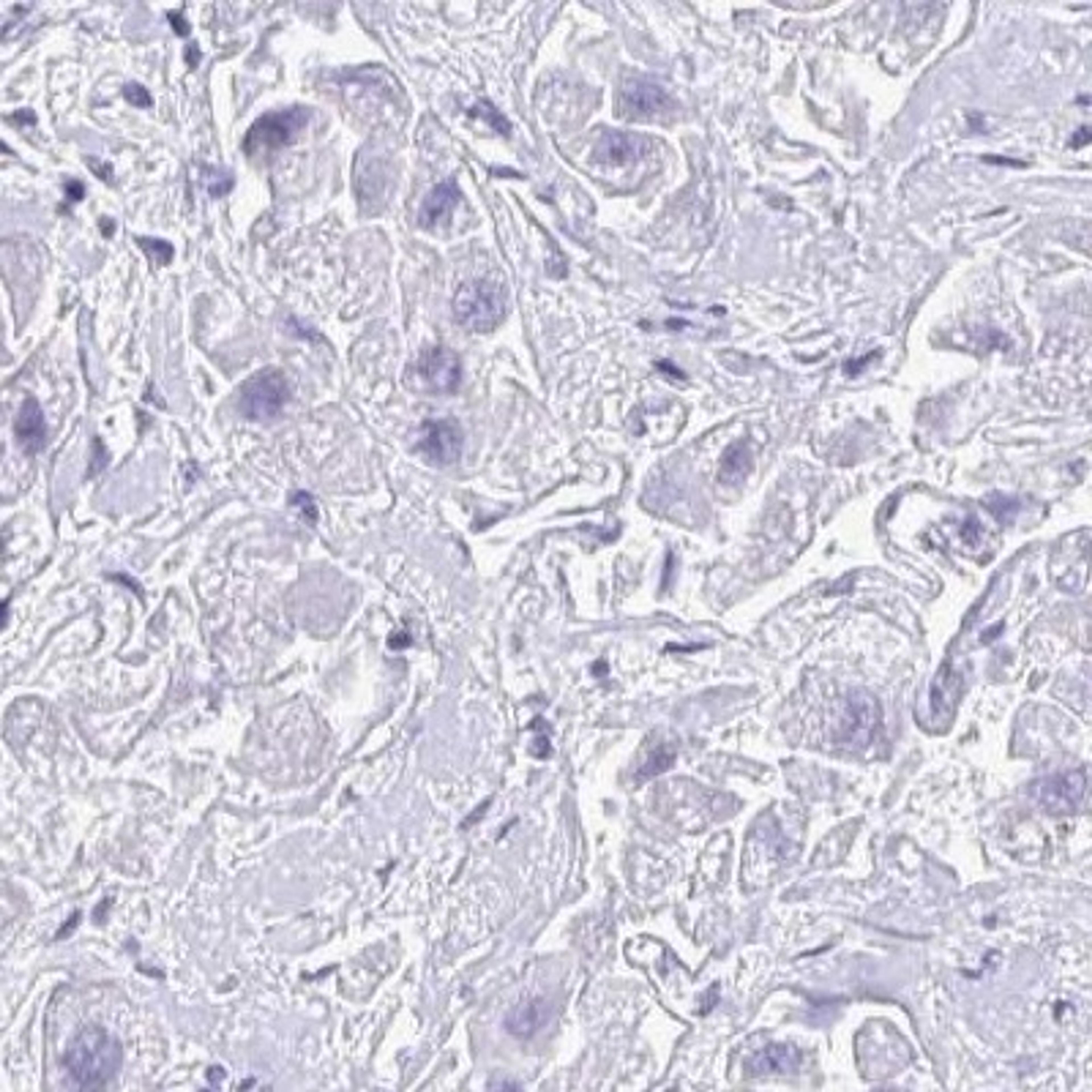 Immunohistochemistry: ANKDD1B Antibody [NBP2-32490] - liver cancer