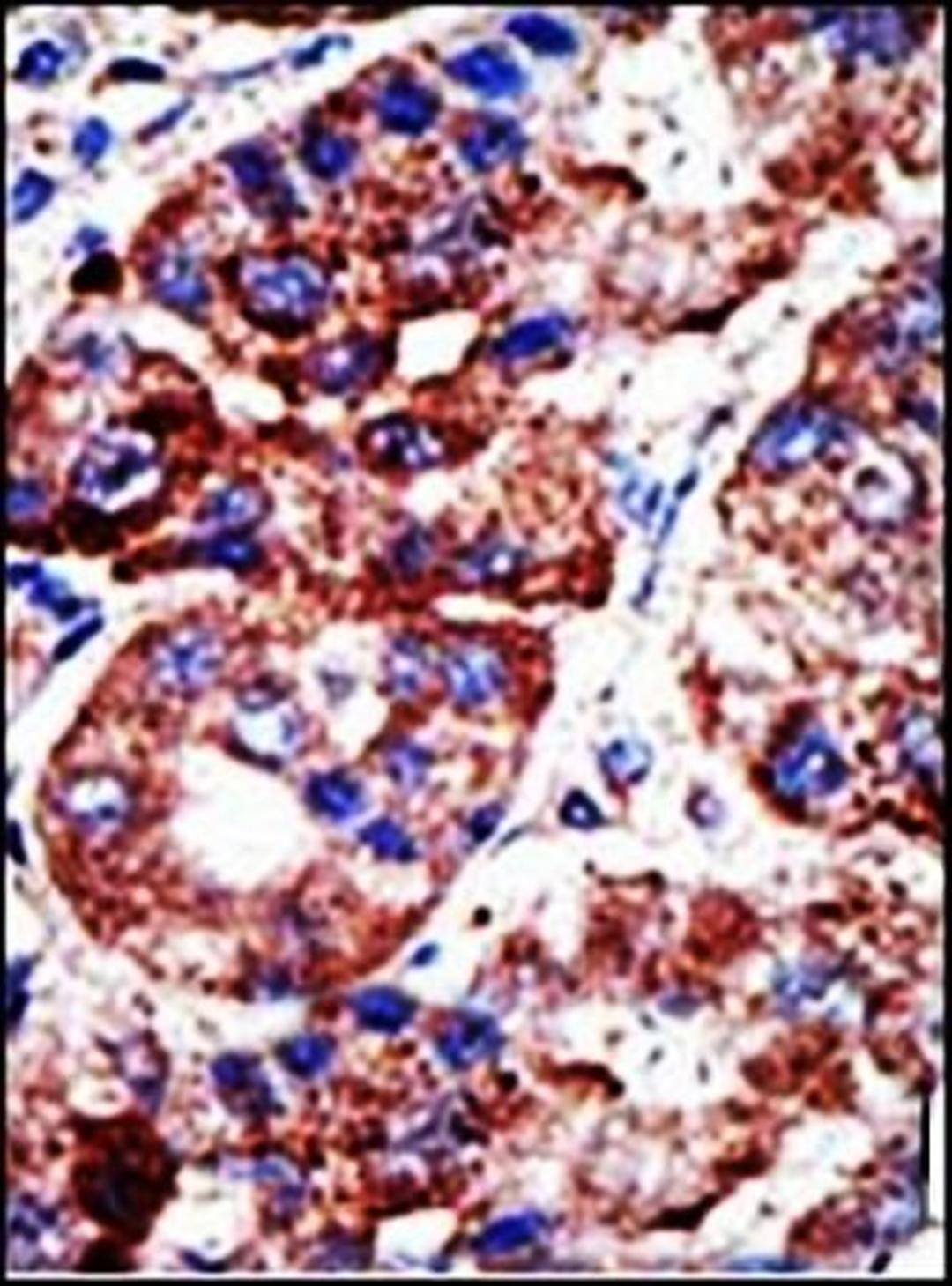 Immunohistochemical analysis of formalin-fixed and paraffin-embedded human cancer tissue using SQSTM1 antibody