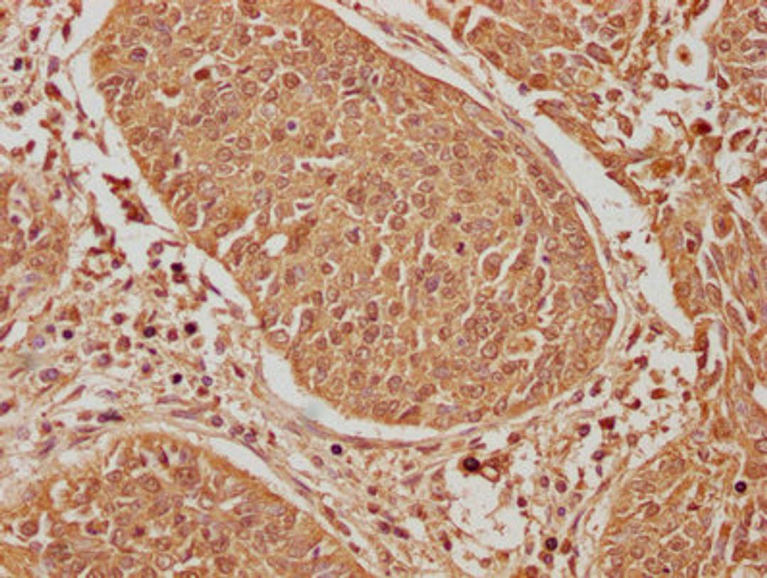 IHC image of CSB-PA007511LA01HU diluted at 1:600 and staining in paraffin-embedded human cervical cancer performed on a Leica BondTM system. After dewaxing and hydration, antigen retrieval was mediated by high pressure in a citrate buffer (pH 6.0). Section was blocked with 10% normal goat serum 30min at RT. Then primary antibody (1% BSA) was incubated at 4°C overnight. The primary is detected by a biotinylated secondary antibody and visualized using an HRP conjugated SP system.