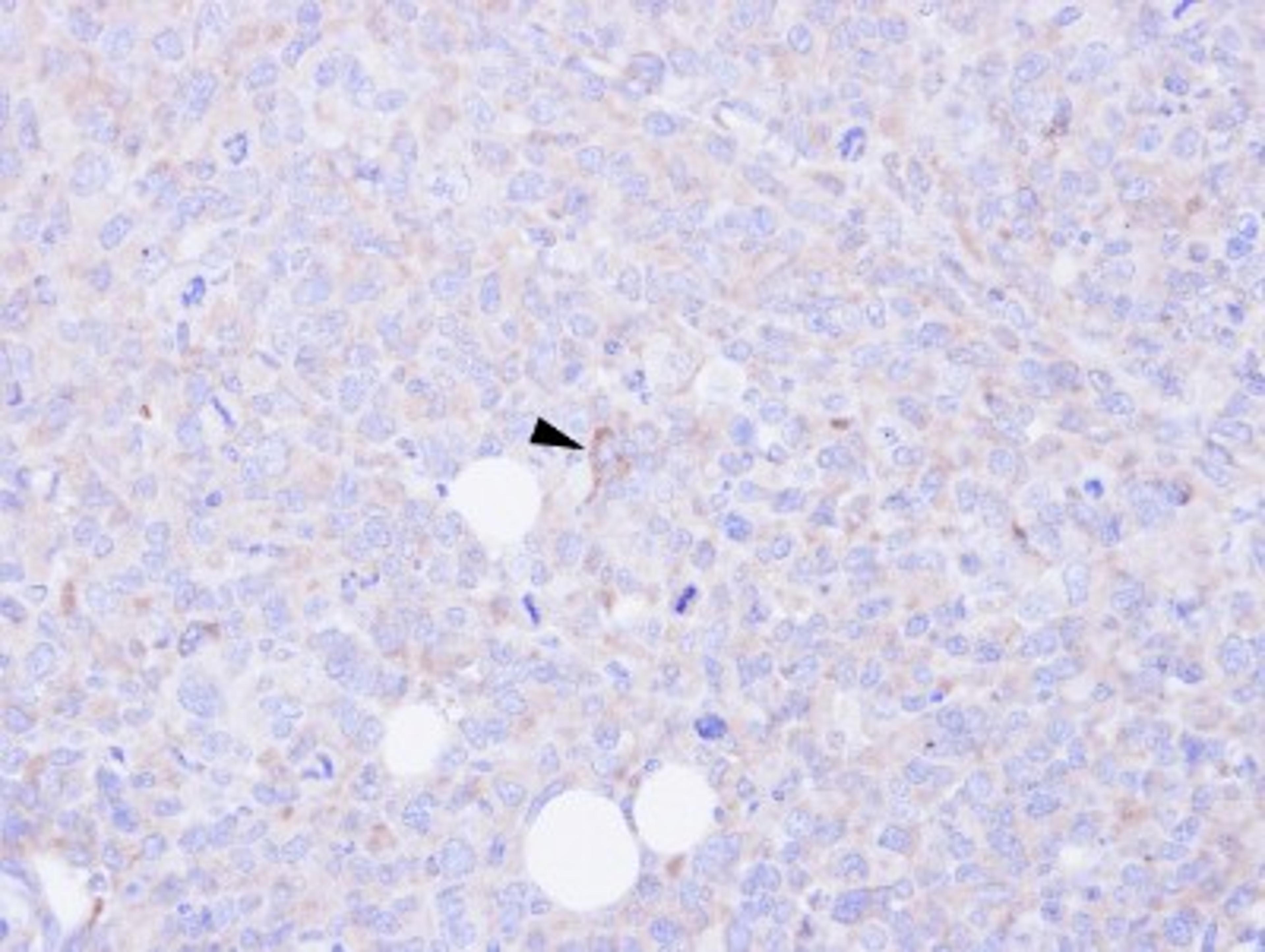 Immunohistochemistry-Paraffin: CARD9 Antibody [NBP1-32982] - Paraffin-embedded H1299 xenograft, using antibody at 1:100 dilution.