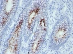 Formalin-fixed, paraffin-embedded human colon carcinoma stained with anti-CEA antibody (SPM506)