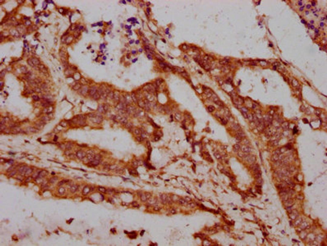 IHC image of CSB-PA013066LA01HU diluted at 1:300 and staining in paraffin-embedded human colon cancer performed on a Leica BondTM system. After dewaxing and hydration, antigen retrieval was mediated by high pressure in a citrate buffer (pH 6.0). Section was blocked with 10% normal goat serum 30min at RT. Then primary antibody (1% BSA) was incubated at 4°C overnight. The primary is detected by a biotinylated secondary antibody and visualized using an HRP conjugated SP system.