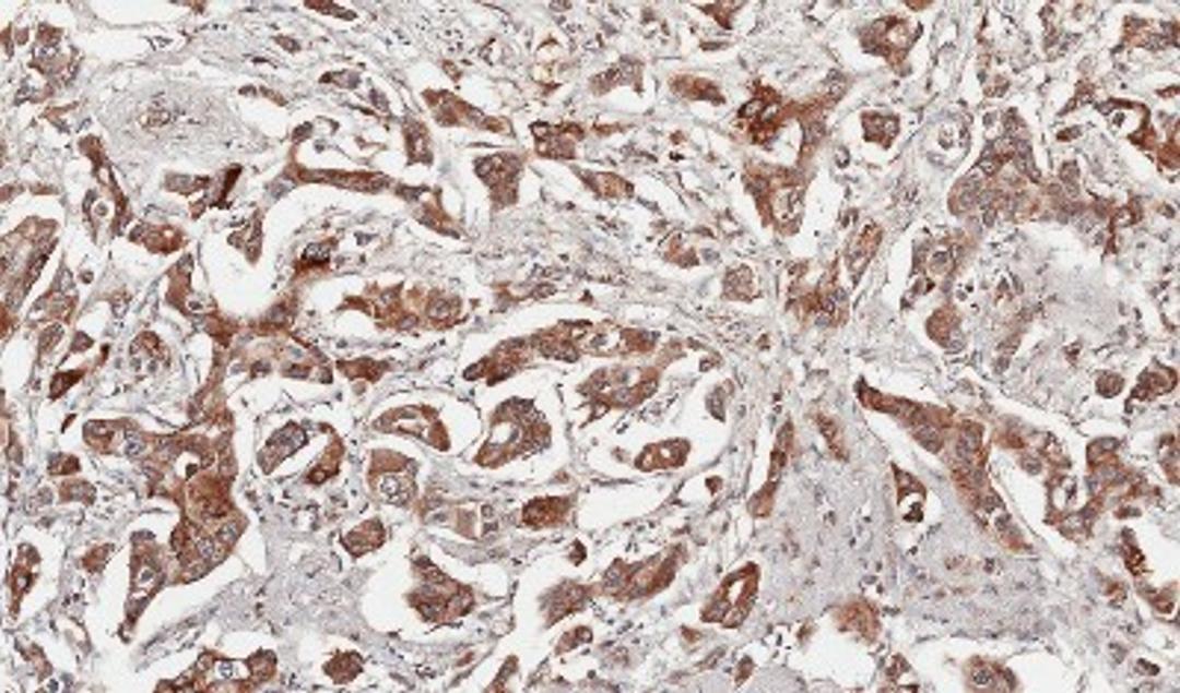 Immunohistochemistry-Paraffin: Growth Hormone Antibody [NBP1-31408] - Paraffin-embedded Breast CA, using antibody at 1:100 dilution.