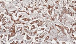 Immunohistochemistry-Paraffin: Growth Hormone Antibody [NBP1-31408] - Paraffin-embedded Breast CA, using antibody at 1:100 dilution.