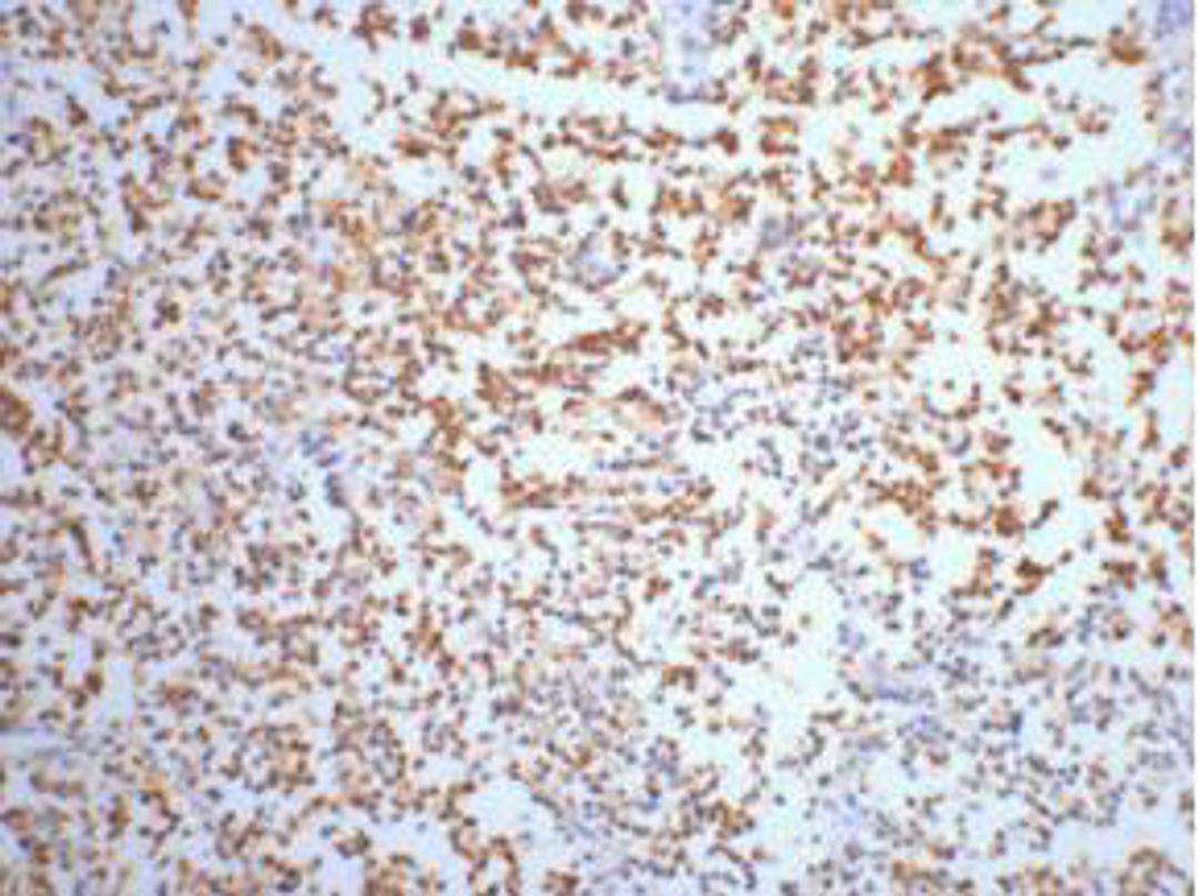 IHC staining of Human small cell carcinoma of lung tissue, diluted at 1:200.