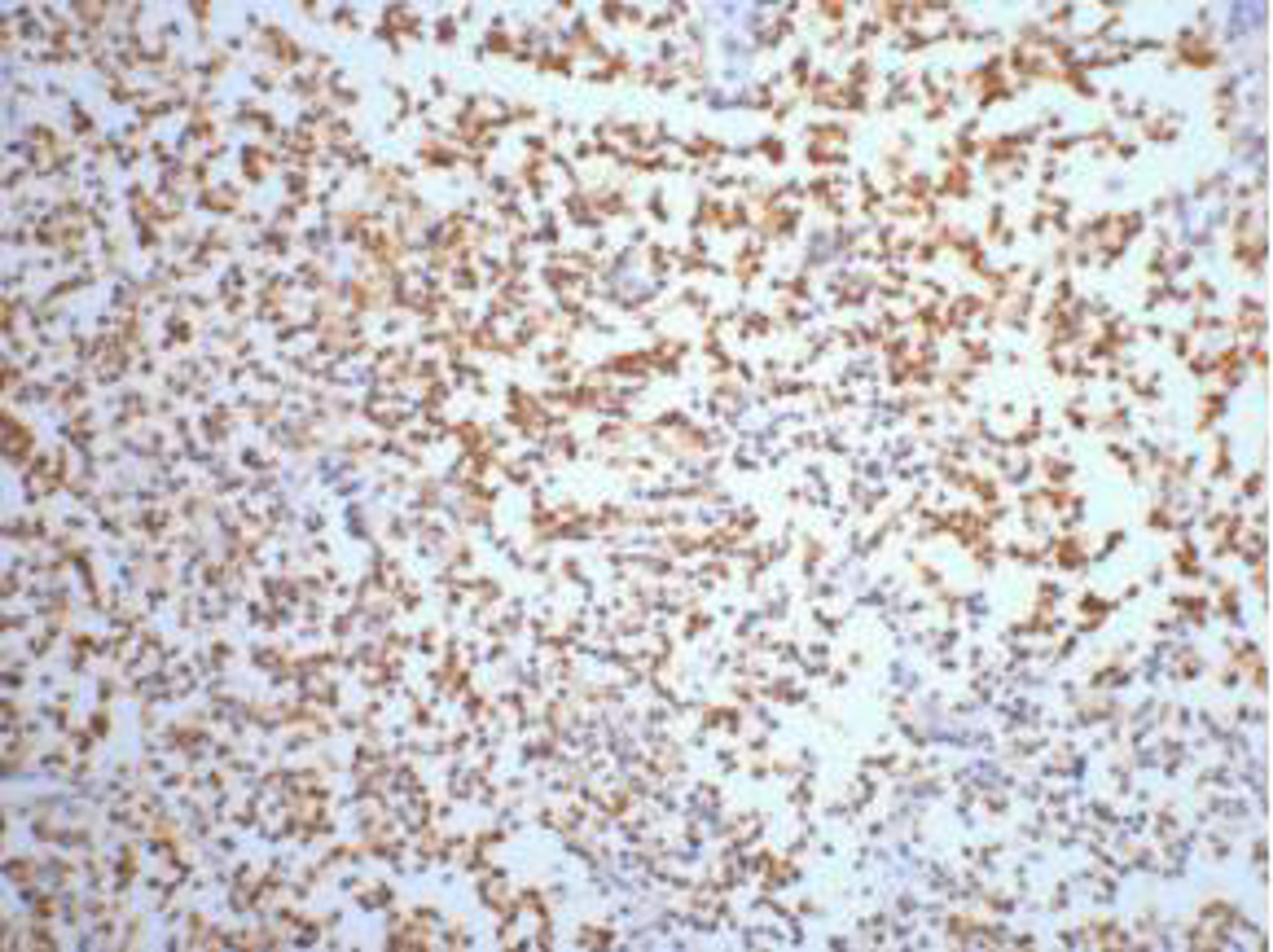 IHC staining of Human small cell carcinoma of lung tissue, diluted at 1:200.