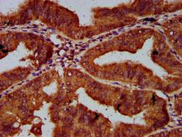 IHC image of CSB-PA617942LA01HU diluted at 1:600 and staining in paraffin-embedded human endometrial cancer performed on a Leica BondTM system. After dewaxing and hydration, antigen retrieval was mediated by high pressure in a citrate buffer (pH 6.0). Section was blocked with 10% normal goat serum 30min at RT. Then primary antibody (1% BSA) was incubated at 4°C overnight. The primary is detected by a biotinylated secondary antibody and visualized using an HRP conjugated SP system.