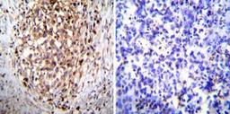 Immunohistochemistry-Paraffin: Hydrogen Potassium ATPase Beta Antibody (2G11) [NB300-583] - Both normal and cancer biopsies of deparaffinized Human gastric carcinoma tissues.