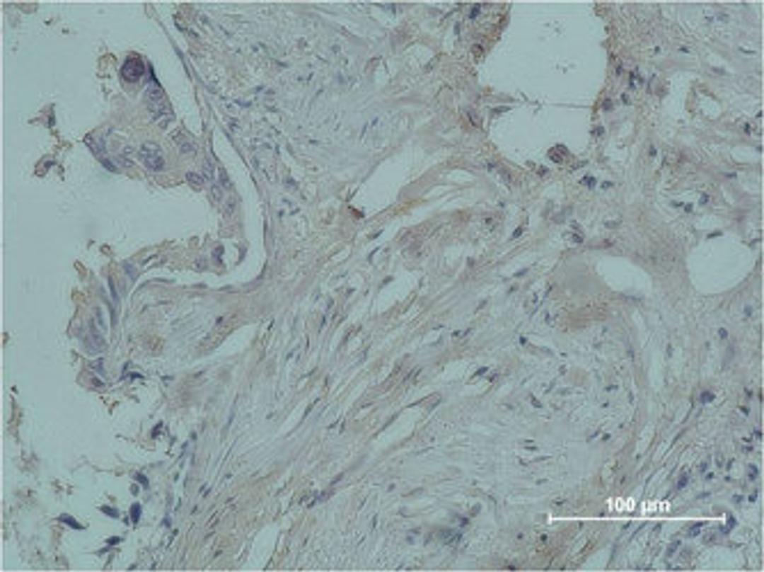 Immunohistochemical analysis of paraffin-embedded human breast caricnoma using PR Monoclonal Antibody.
