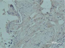Immunohistochemical analysis of paraffin-embedded human breast caricnoma using PR Monoclonal Antibody.