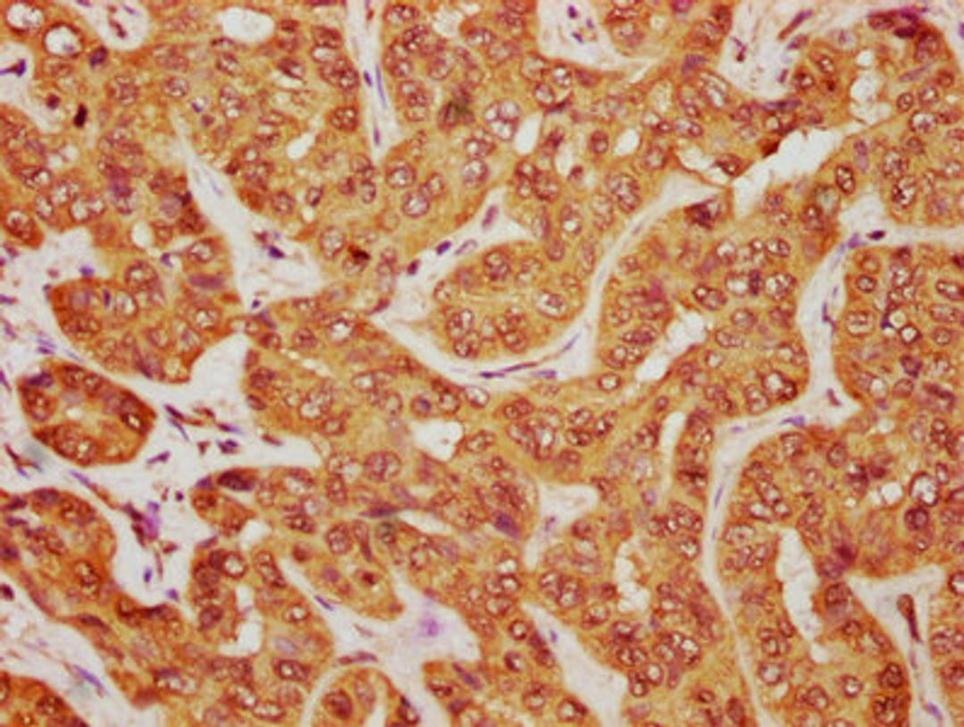 IHC image of CSB-PA762574HA01HU diluted at 1:1200 and staining in paraffin-embedded human liver cancer performed on a Leica BondTM system. After dewaxing and hydration, antigen retrieval was mediated by high pressure in a citrate buffer (pH 6.0). Section was blocked with 10% normal goat serum 30min at RT. Then primary antibody (1% BSA) was incubated at 4°C overnight. The primary is detected by a biotinylated secondary antibody and visualized using an HRP conjugated SP system.