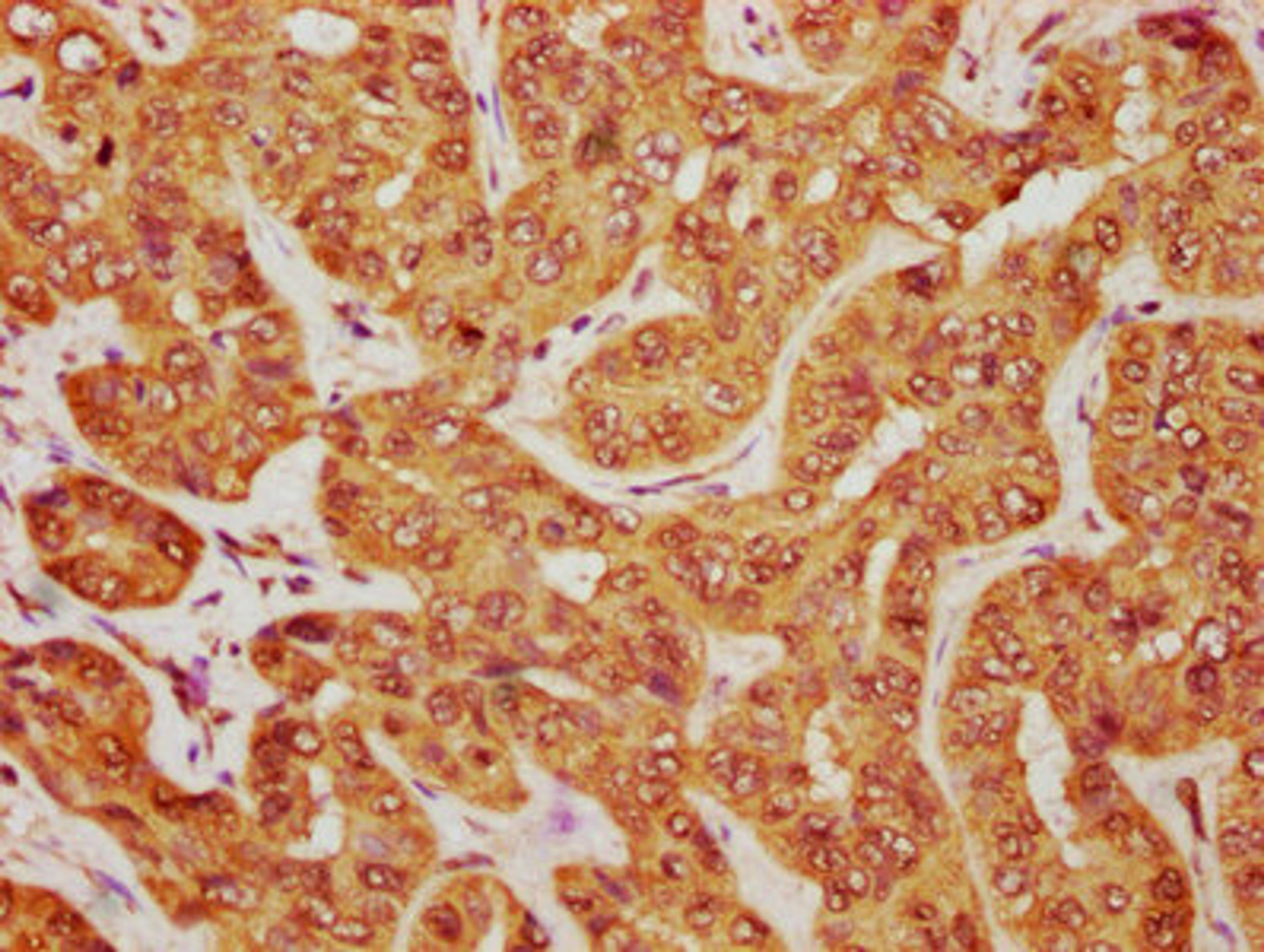 IHC image of CSB-PA762574HA01HU diluted at 1:1200 and staining in paraffin-embedded human liver cancer performed on a Leica BondTM system. After dewaxing and hydration, antigen retrieval was mediated by high pressure in a citrate buffer (pH 6.0). Section was blocked with 10% normal goat serum 30min at RT. Then primary antibody (1% BSA) was incubated at 4°C overnight. The primary is detected by a biotinylated secondary antibody and visualized using an HRP conjugated SP system.