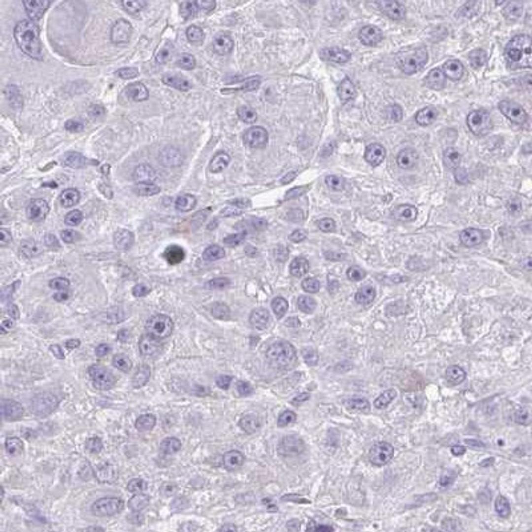 Immunohistochemistry: FAM162B Antibody [NBP2-32533] - liver cancer