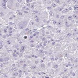 Immunohistochemistry: FAM162B Antibody [NBP2-32533] - liver cancer