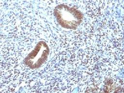 Immunohistochemical staining of human Uterine Carcinoma tissue using MAP3K1 antibody