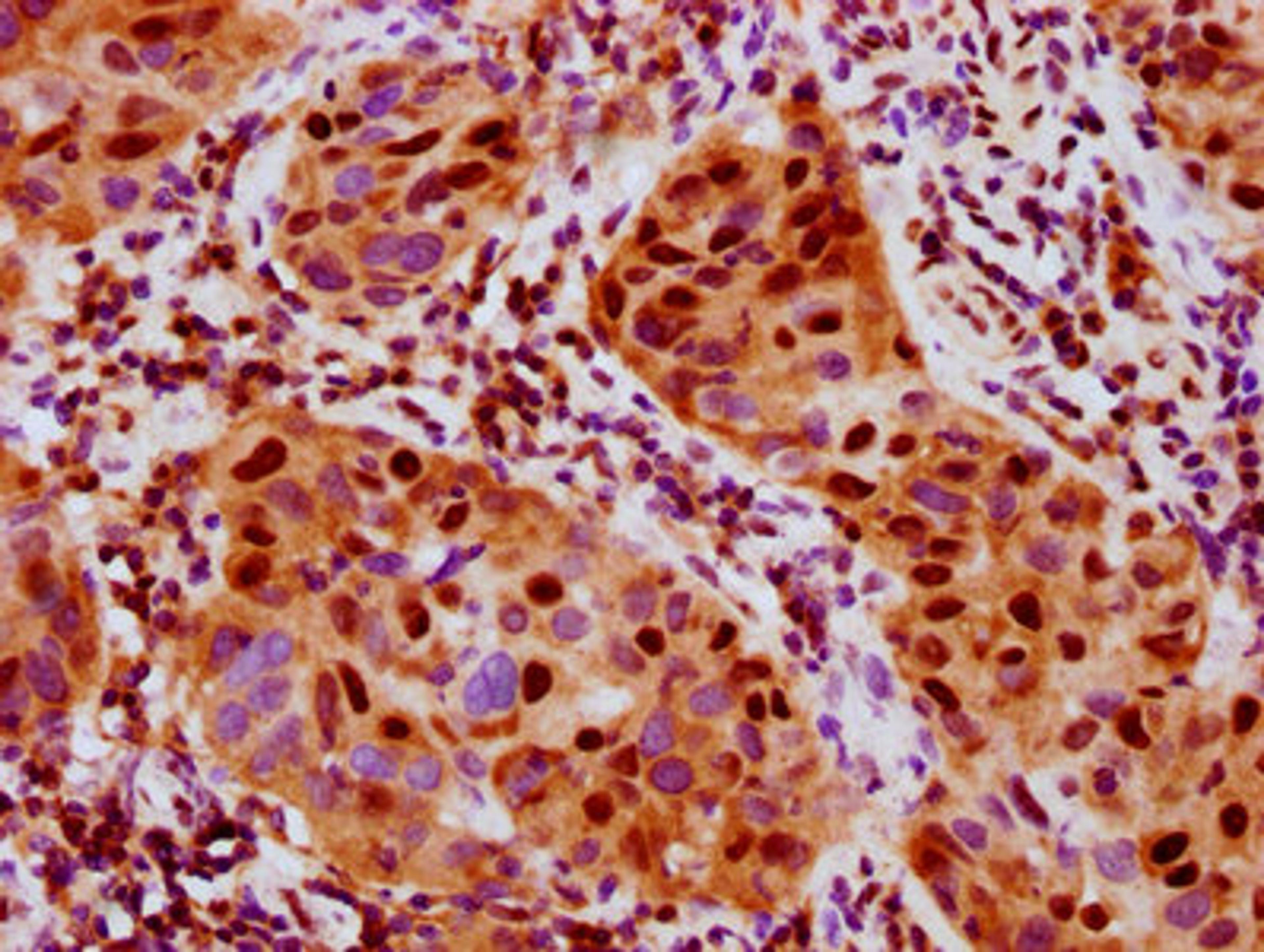IHC image of CSB-RA020468A376phHU diluted at 1:100 and staining in paraffin-embedded human bladder cancer performed on a Leica BondTM system. After dewaxing and hydration, antigen retrieval was mediated by high pressure in a citrate buffer (pH 6.0). Section was blocked with 10% normal goat serum 30min at RT. Then primary antibody (1% BSA) was incubated at 4℃ overnight. The primary is detected by a biotinylated secondary antibody and visualized using an HRP conjugated SP system.
