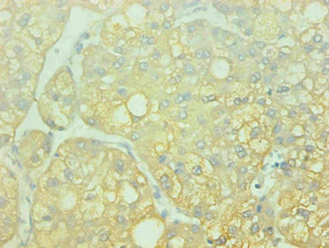 Immunohistochemical of paraffin-embedded human liver cancer using CSB-MA0014851A0m at dilution of 1:200