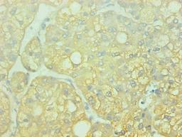Immunohistochemical of paraffin-embedded human liver cancer using CSB-MA0014851A0m at dilution of 1:200