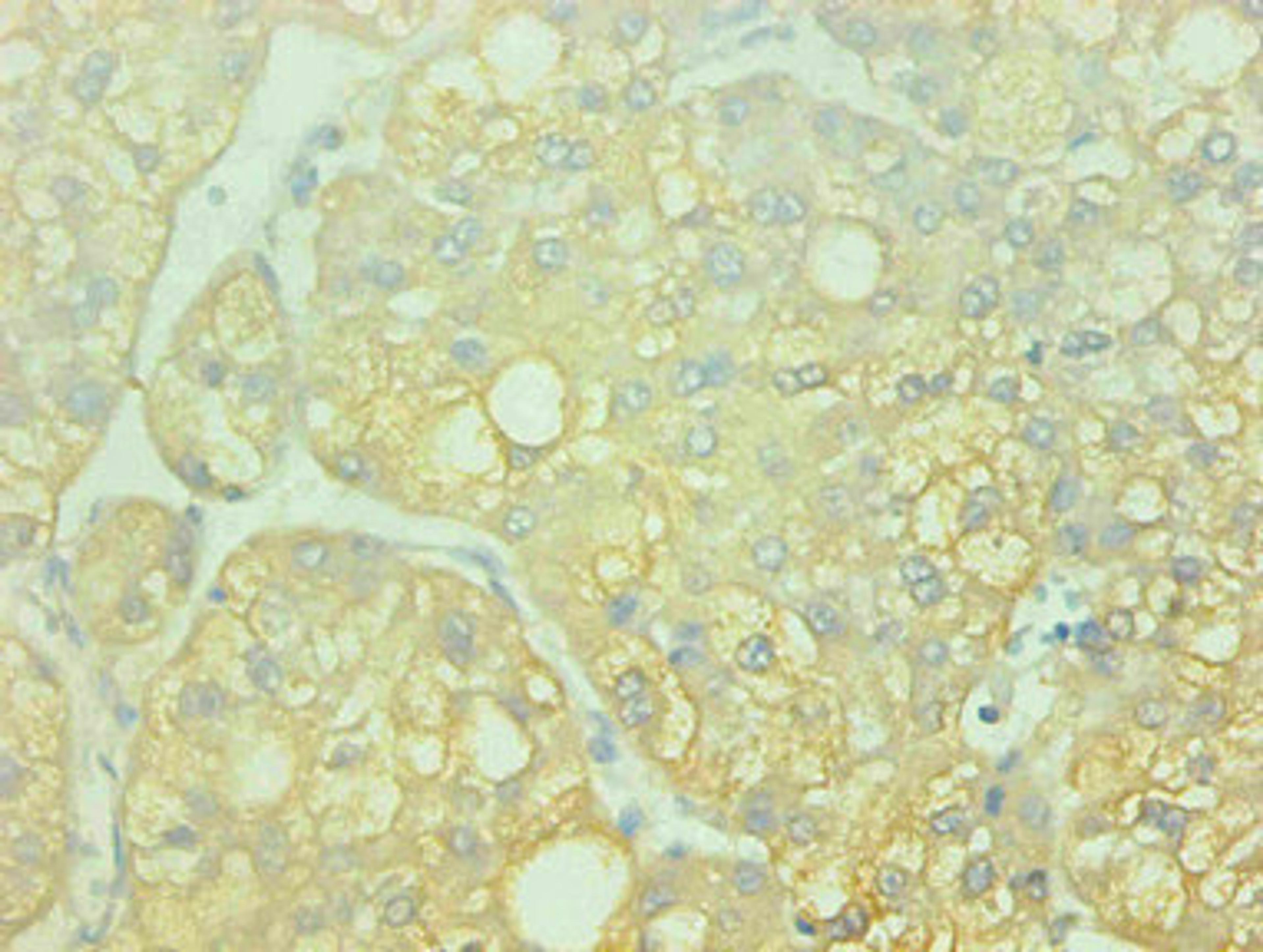 Immunohistochemical of paraffin-embedded human liver cancer using CSB-MA0014851A0m at dilution of 1:200