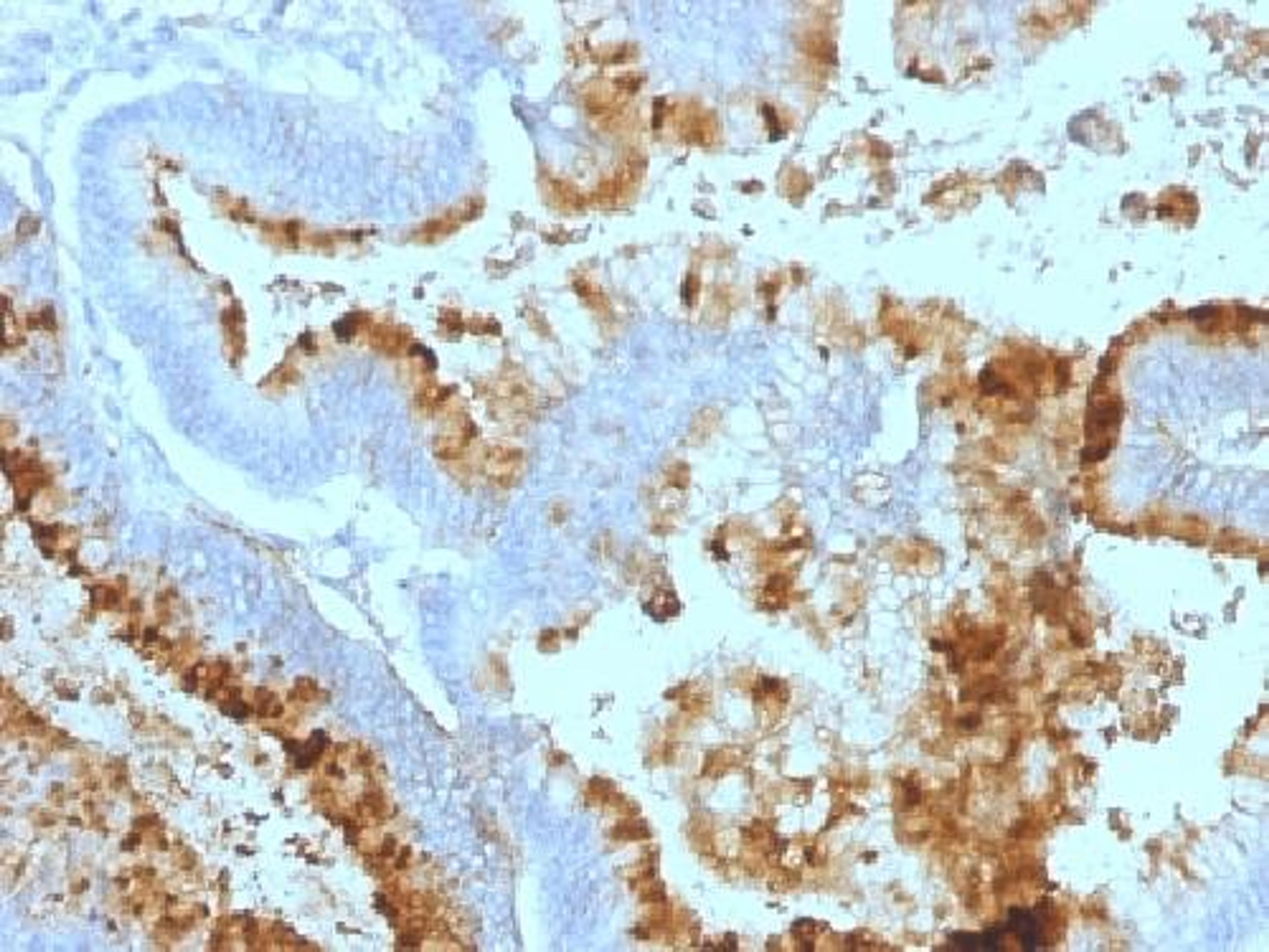 Immunohistochemical staining of human Colon carcinoma tissue using Lewis A antibody