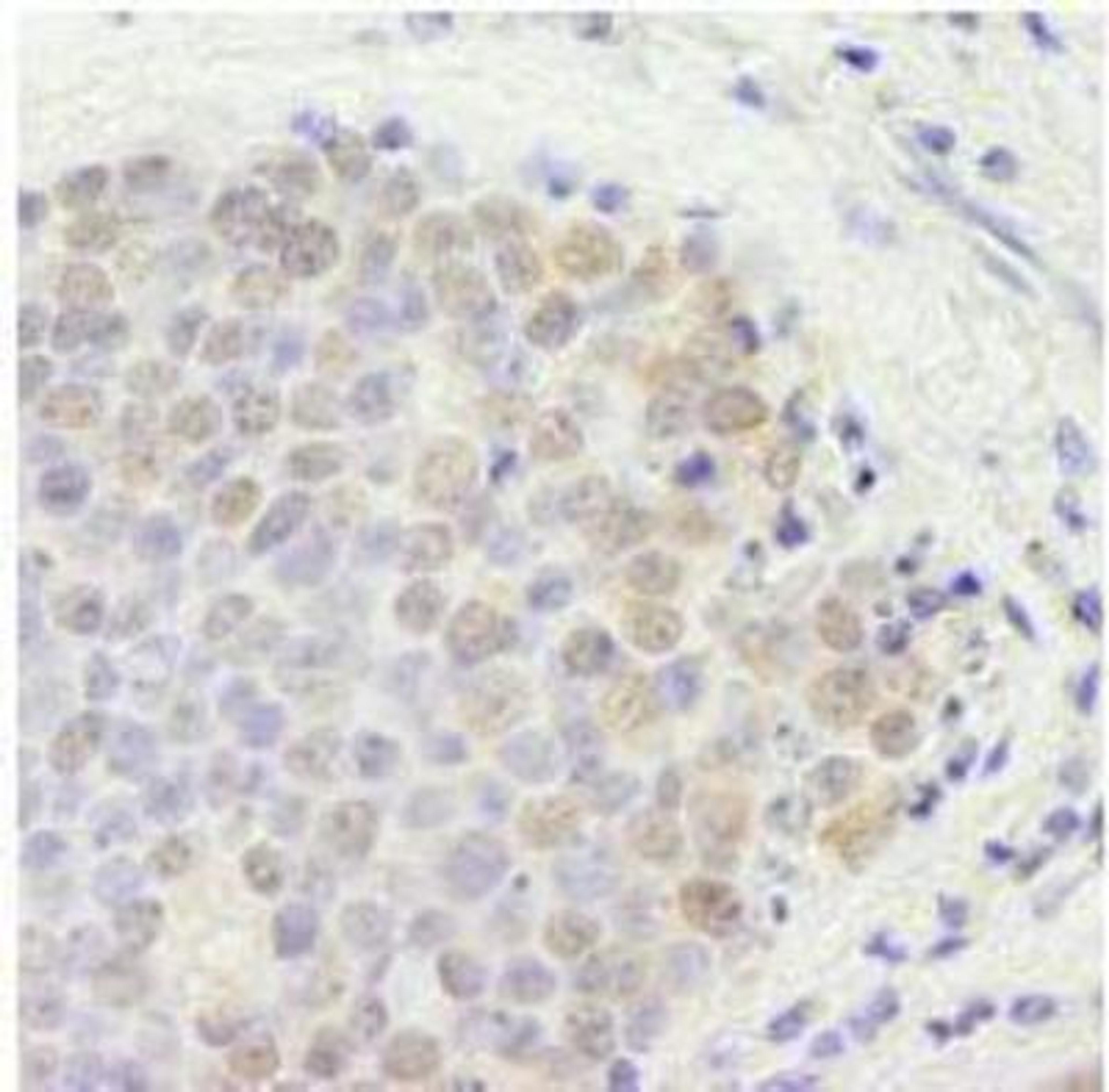 Immunohistochemistry-Paraffin: p66 beta Antibody [NB100-60646] - Human small cell lung cancer. Antibody: Affinity purified rabbit antip66beta/ GATAD2B used at a dilution of 1:250.