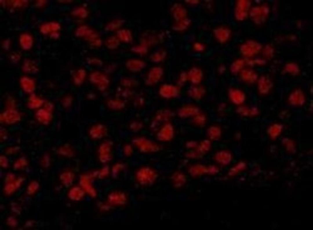 Immunocytochemistry/Immunofluorescence: BAF53A Antibody [NB100-61628] - Section of human breast carcinoma. Antibody: Affinity purified rabbit anti-BAF53A used at a dilution of 1:100. Detection: Red-fluorescent goat anti-rabbit IgG highly cross-adsorbed Antibody Hilyte PlusTM 555 used at a dilution of 1:100.