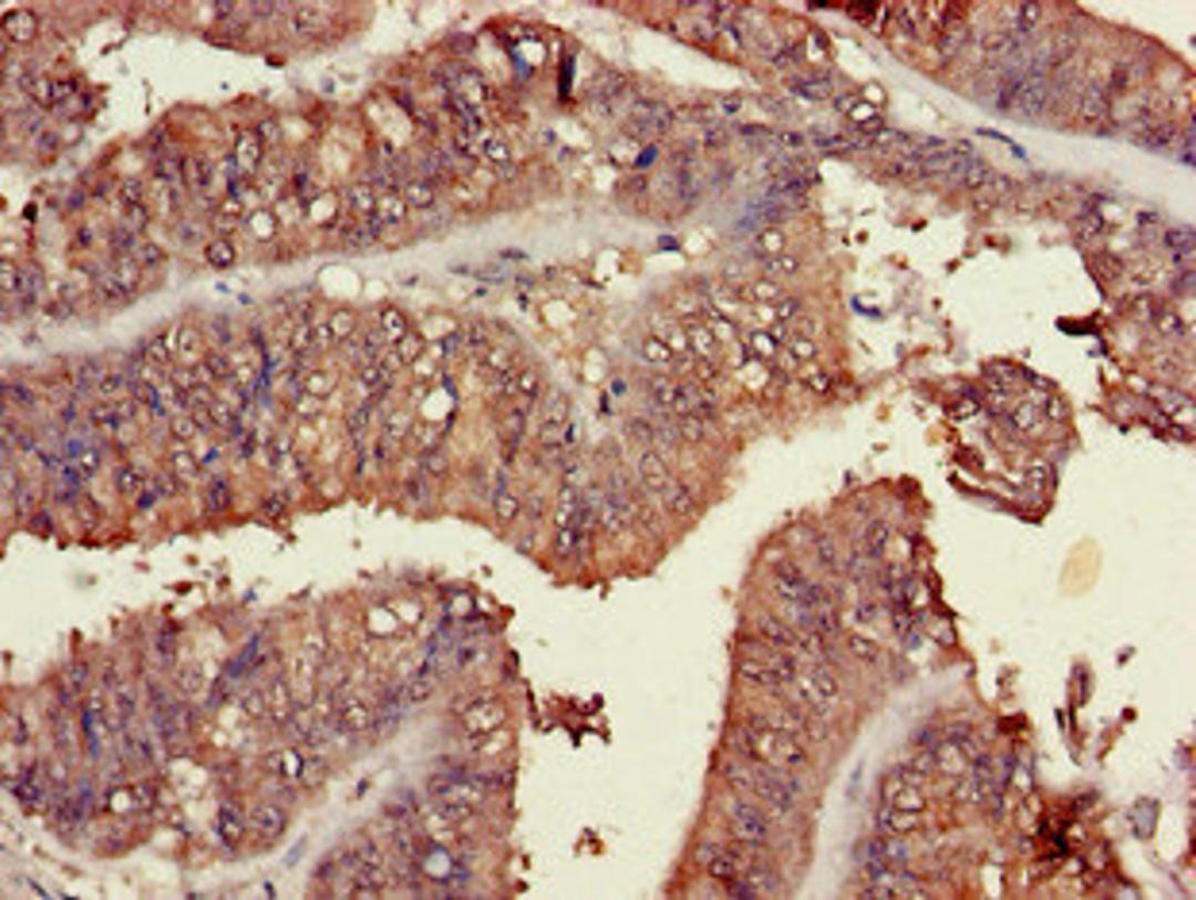 Immunohistochemistry of paraffin-embedded human endometrial cancer using CSB-PA861180LA01HU at dilution of 1:100