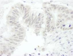 Immunohistochemistry-Paraffin: ASH1 Antibody [NB100-93290] - Human stomach carcinoma.