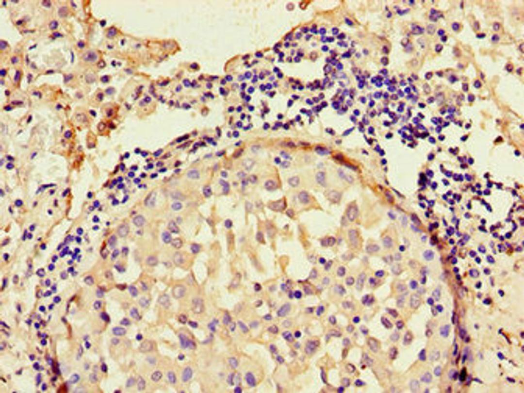 Immunohistochemistry of paraffin-embedded human lung cancer using CSB-PA653477LA01HU at dilution of 1:100