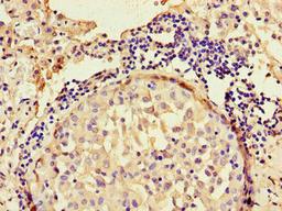 Immunohistochemistry of paraffin-embedded human lung cancer using CSB-PA653477LA01HU at dilution of 1:100