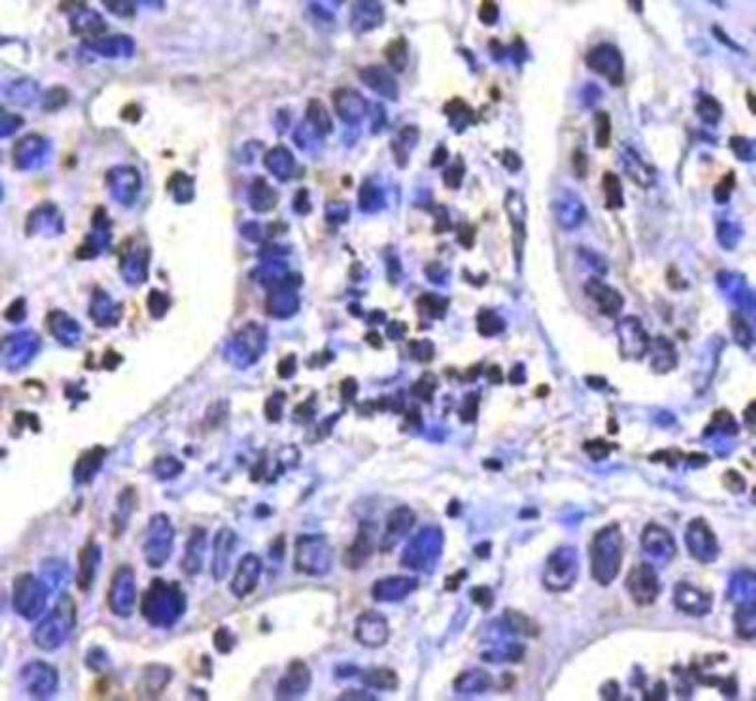 Immunohistochemical staining of human gastric carcinoma tissue using Ikk alpha antibody