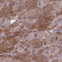 Immunohistochemistry: EXOC6B Antibody [NBP2-31869] - liver cancer