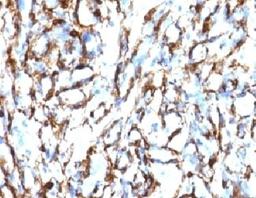 IHC testing of FFPE human angiosarcoma with Smooth Muscle Actin antibody (clone SMAT2-1).