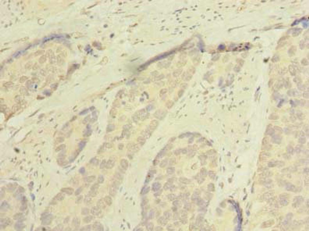 Immunohistochemistry of paraffin-embedded human gastric cancer using CSB-PA845158LA01HU at dilution of 1:100