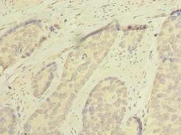 Immunohistochemistry of paraffin-embedded human gastric cancer using CSB-PA845158LA01HU at dilution of 1:100
