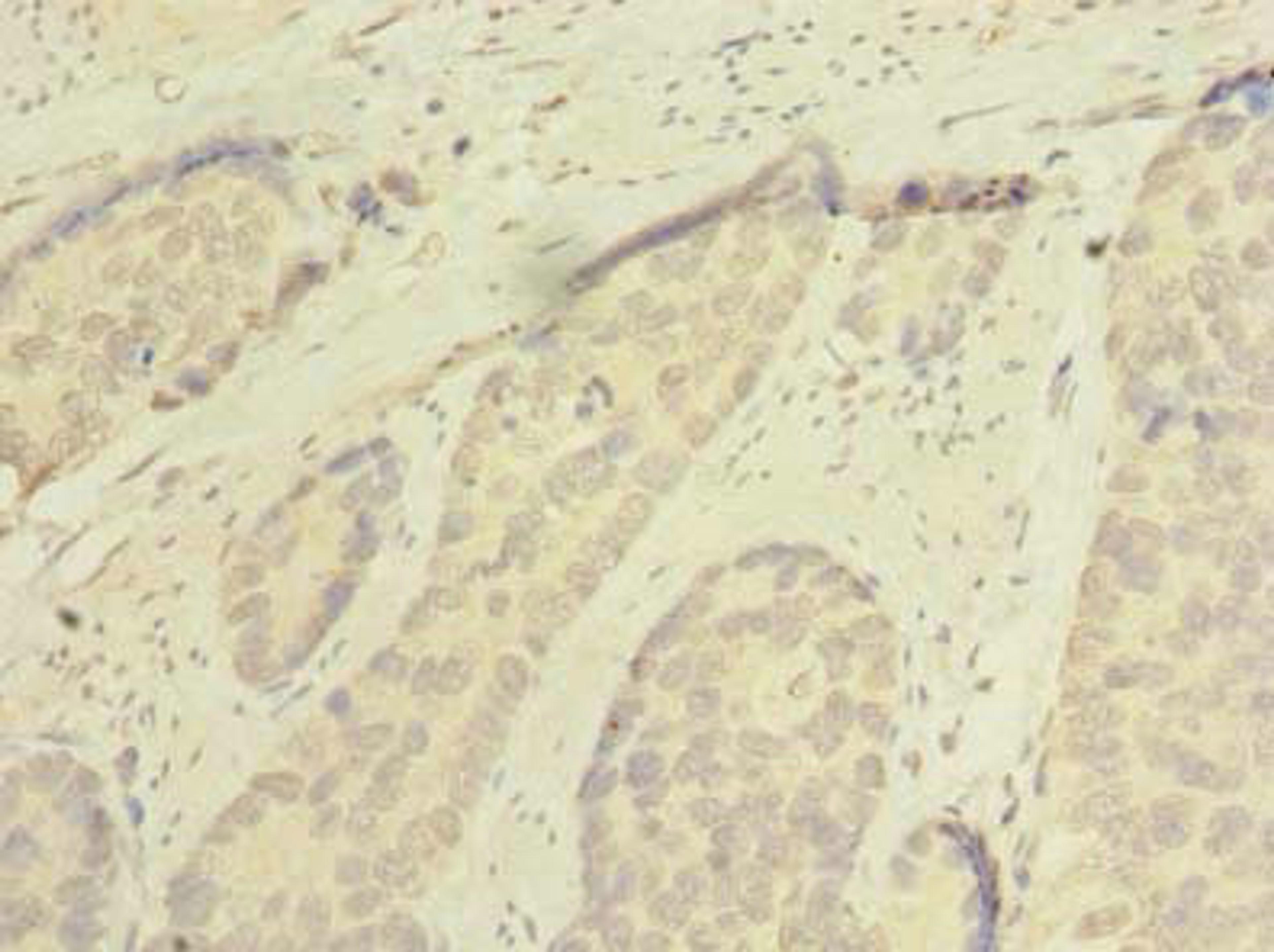 Immunohistochemistry of paraffin-embedded human gastric cancer using CSB-PA845158LA01HU at dilution of 1:100