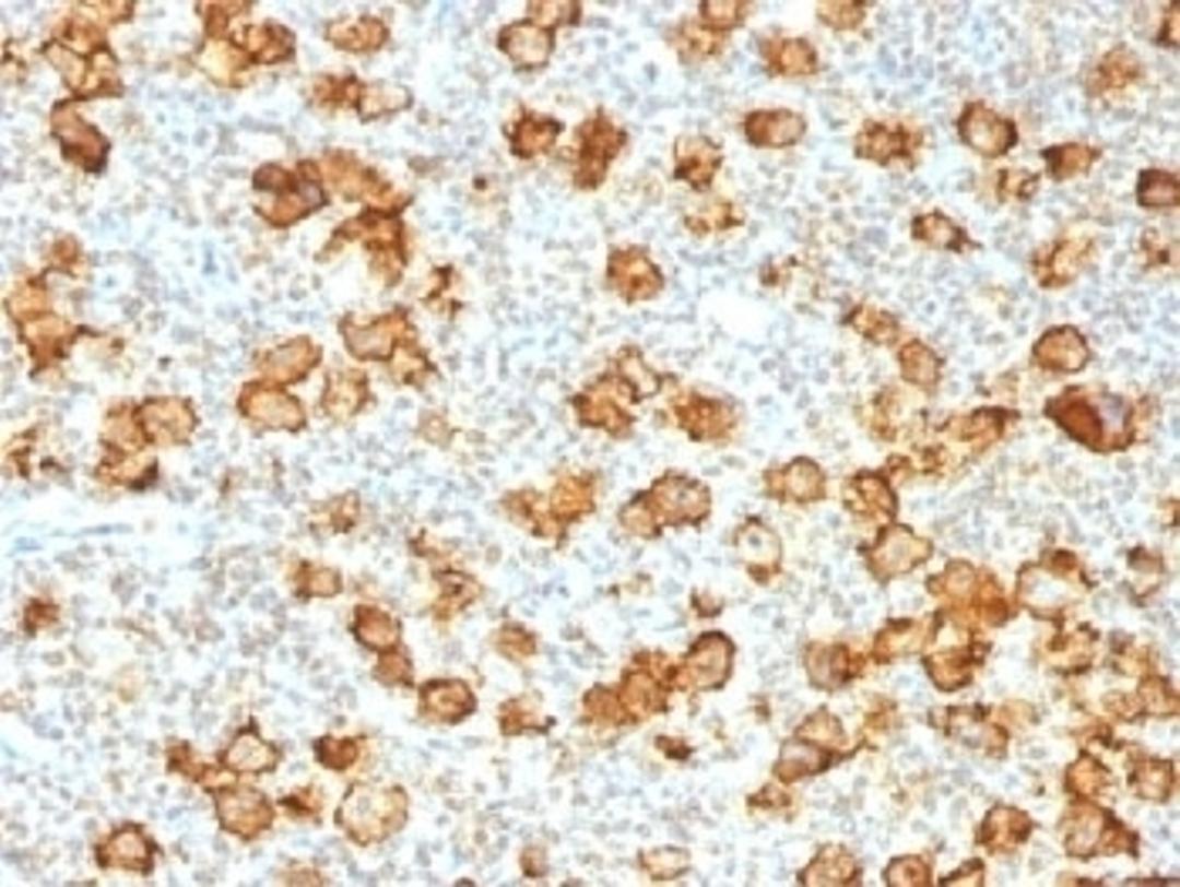 IHC testing of FFPE human Hodgkin's lymphoma stained with recombinant CD30 antibody (clone Ki-1/1505R). Required HIER: steam sections in pH9, 1mM EDTA for 10-20 min.