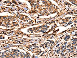 The image on the left is immunohistochemistry of paraffin-embedded Human breast cancer tissue using CSB-PA197126(ANXA6 Antibody) at dilution 1/17, on the right is treated with fusion protein. (Original magnification: ×200)