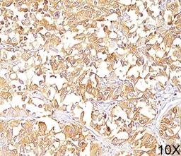 IHC staining of human melanoma (10X) with gp100 antibody (HMB45).