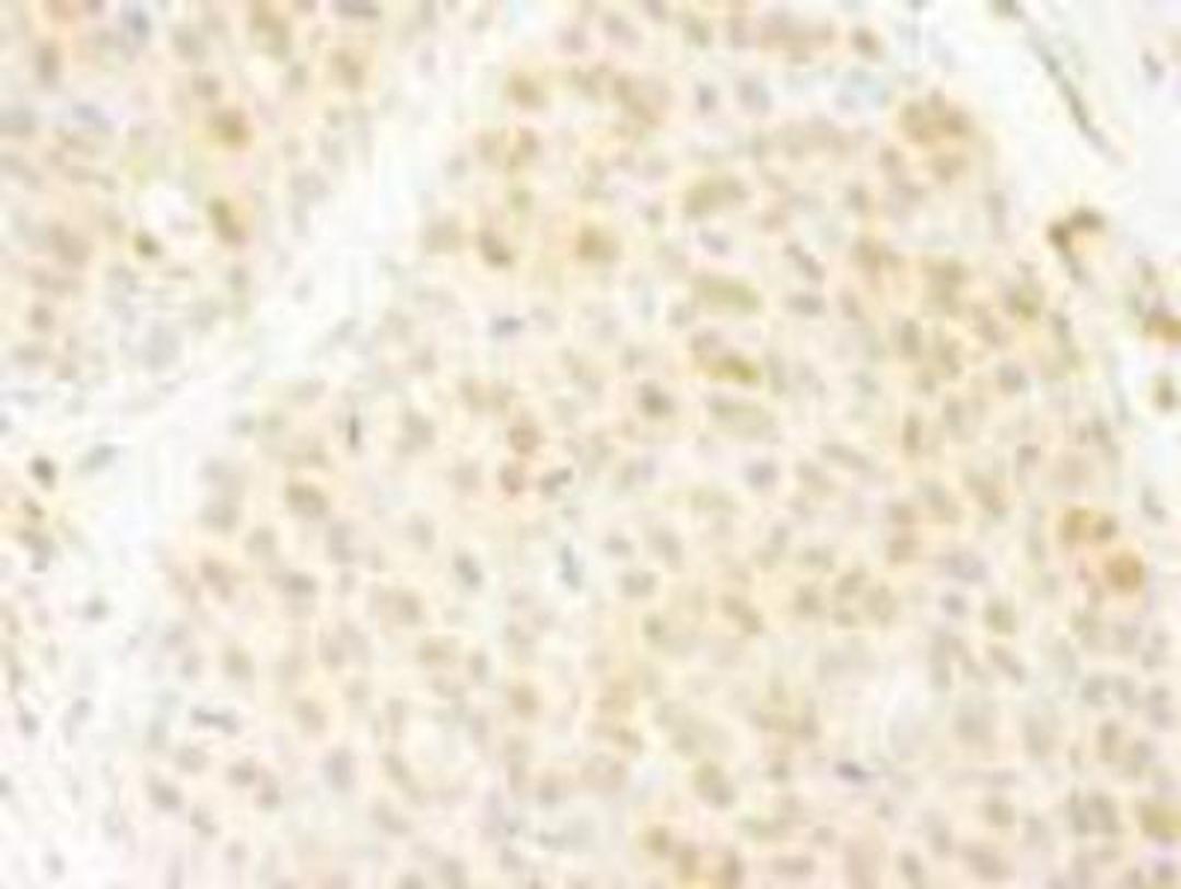 Immunohistochemistry-Paraffin: ANKRD17 Antibody [NB100-86996] - FFPE section of human breast carcinoma.  Antibody used at a dilution of 1:250.