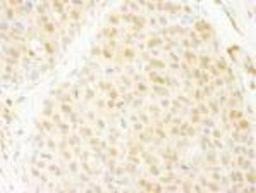 Immunohistochemistry-Paraffin: ANKRD17 Antibody [NB100-86996] - FFPE section of human breast carcinoma.  Antibody used at a dilution of 1:250.