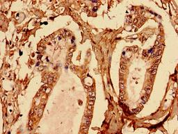 Immunohistochemistry analysis of human pancreatic cancer using CSB-PA002683EA01HU at dilution of 1:100