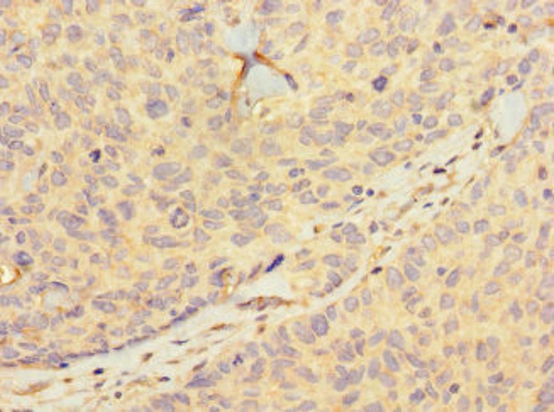 Immunohistochemistry of paraffin-embedded human ovarian cancer using CSB-PA010404LA01HU at dilution of 1:100
