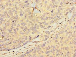 Immunohistochemistry of paraffin-embedded human ovarian cancer using CSB-PA010404LA01HU at dilution of 1:100