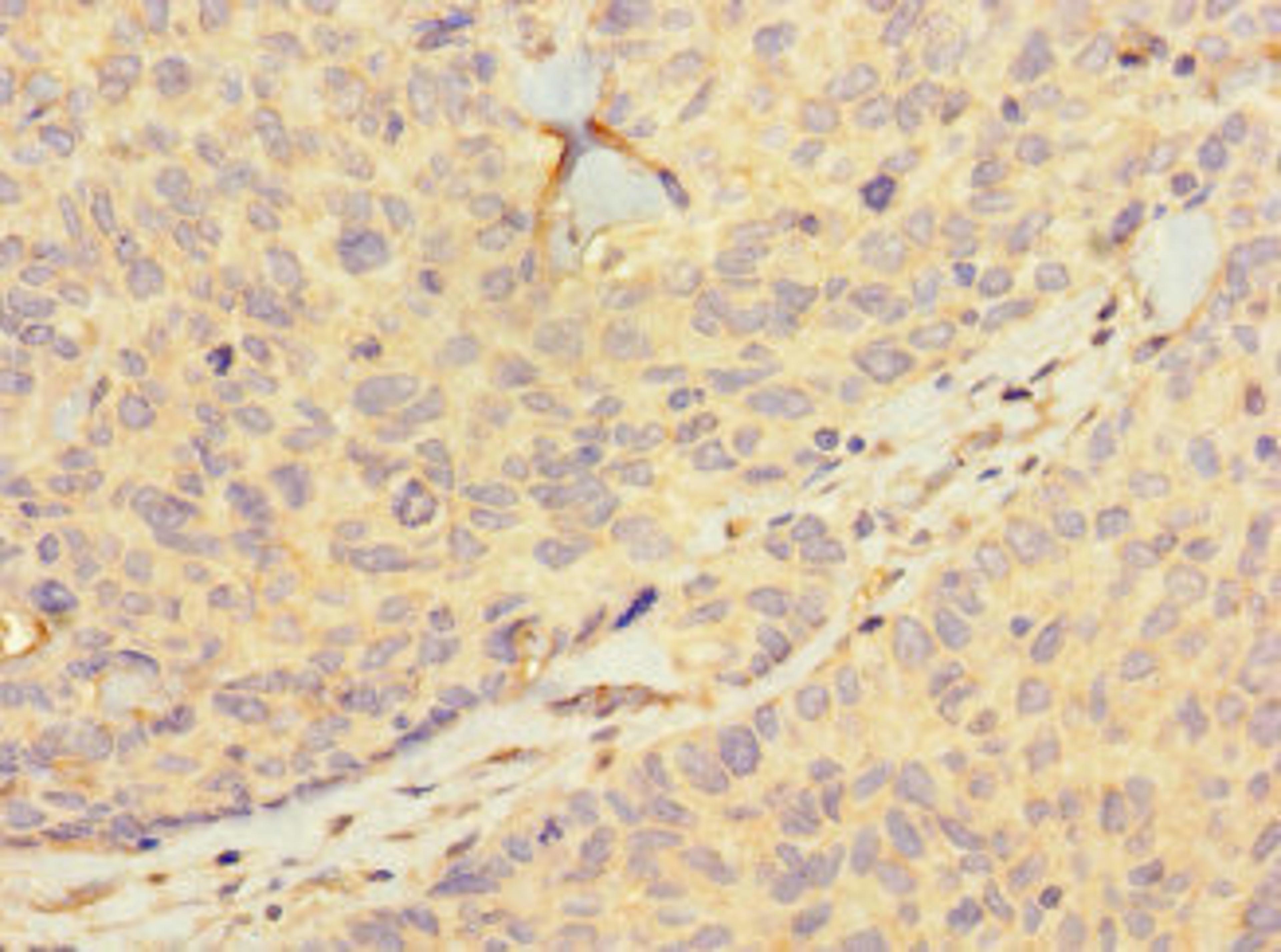 Immunohistochemistry of paraffin-embedded human ovarian cancer using CSB-PA010404LA01HU at dilution of 1:100