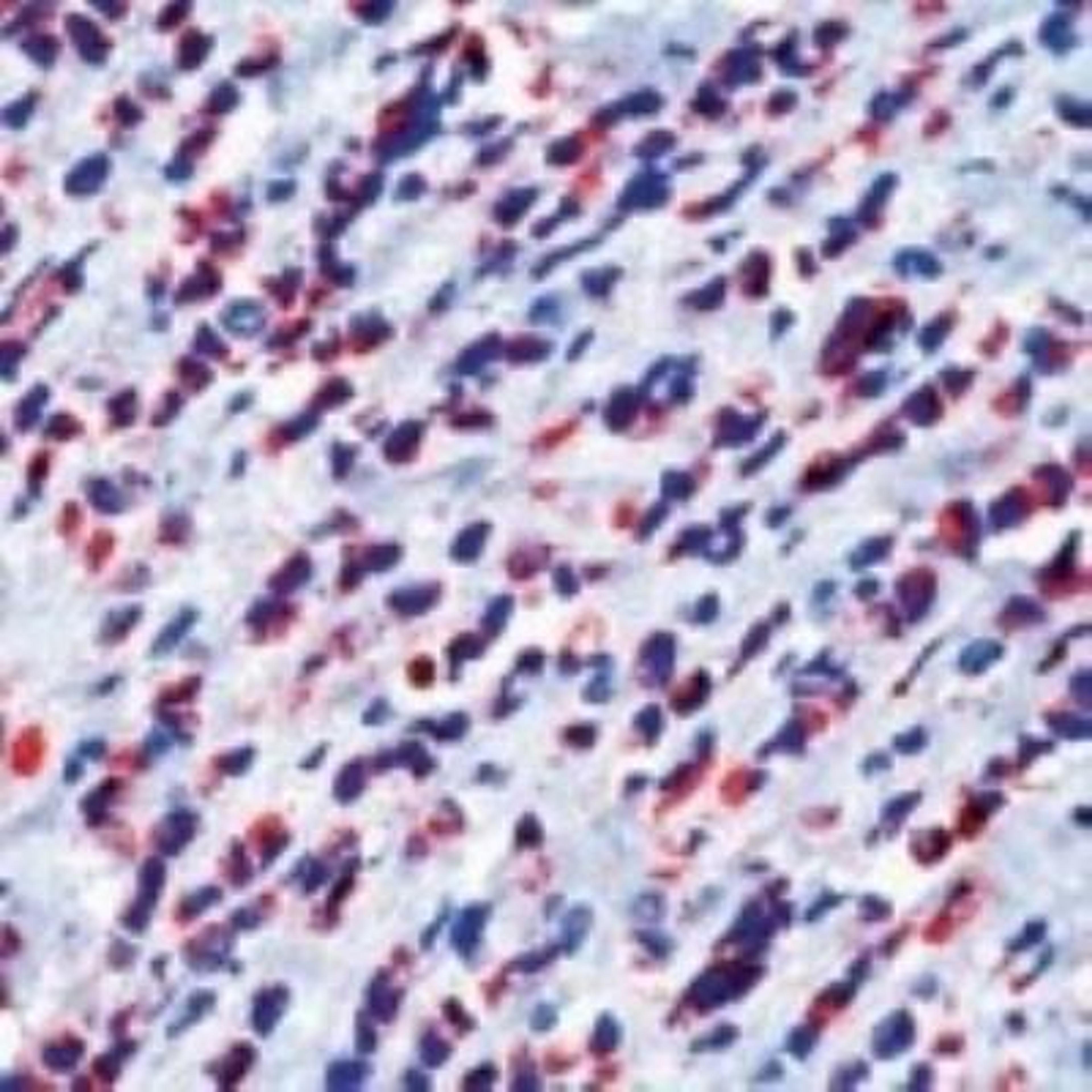 Immunohistochemistry-Paraffin: pan Cadherin Antibody (CH-19) [NB100-1907] - Analysis of pan Cadherin formalin-fixed paraffin embedded human breast carcinoma.