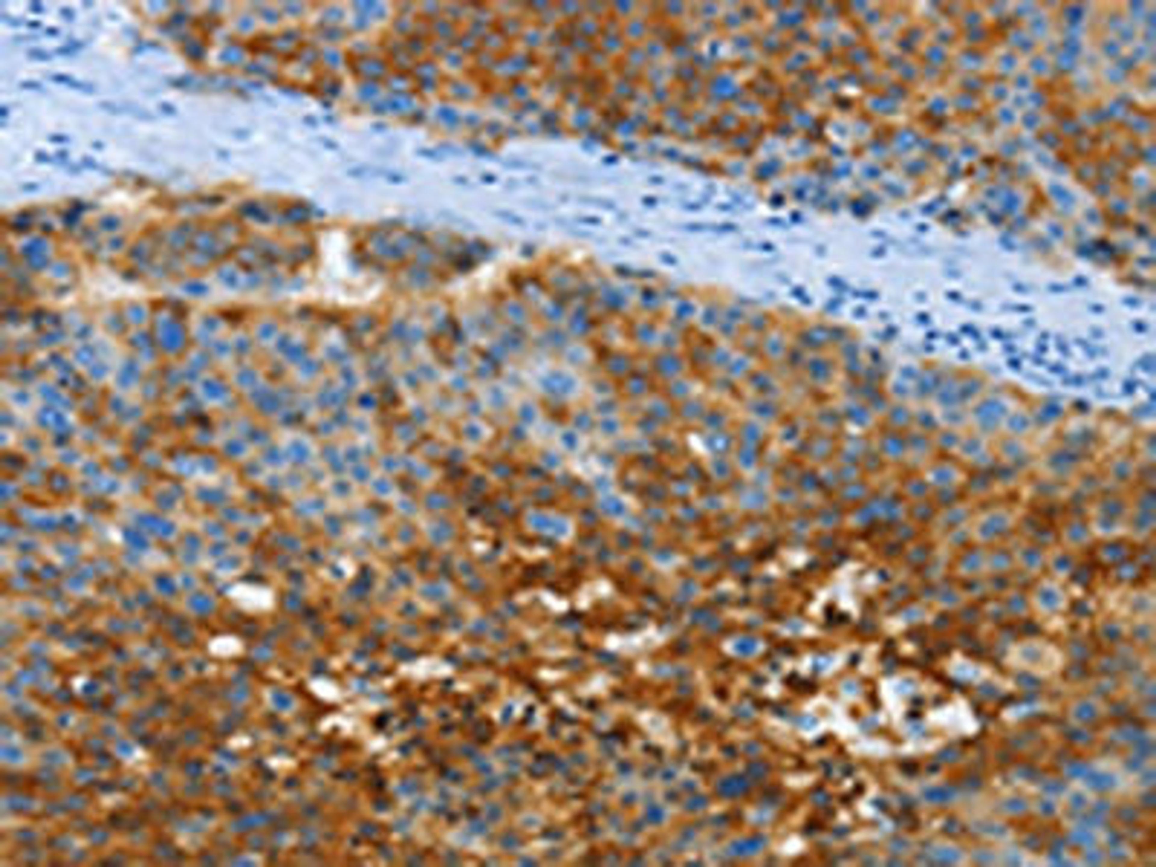 The image on the left is immunohistochemistry of paraffin-embedded Human liver cancer tissue using CSB-PA151772(ANXA13 Antibody) at dilution 1/40, on the right is treated with fusion protein. (Original magnification: ×200)